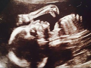 Unik, Ada Dinosaurus Muncul di Foto USG Wanita Hamil Ini!