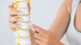 Osteoporosis Adalah: Penyebab Tulang Keropos dan Gejalanya