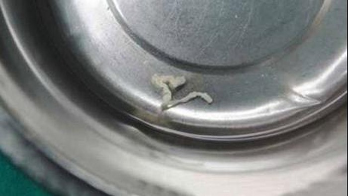 Muntah Usai Makan Salmon Mentah, Ternyata Ada Larva Cacing di Usus Wanita Ini