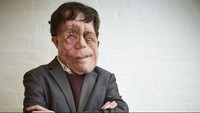 Adam Pearson memiliki kondisi neurofibromatosis tipe 1 yang menyebabkan tumor-tumor jinak tumbuh di sekitar ujung saraf. Pada kasus Adam tumor tumbuh di wajahnya. Ketika dirinya masih bersekolah teman-teman sering menghina namun tak ada tindakan yang dilakukan oleh sekolah. Misi Adam saat ini adalah memberikan kesadaraan tentang hate crimes kepada anak-anak di sekolah. Ia berharap anak-anak akan bisa lebih mengerti tentang dampak dari kata-kata dan perilaku seseorang terhadap orang lain.