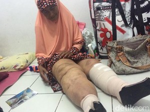 Indonesia Targetkan Bebas Kaki Gajah Tahun 2020