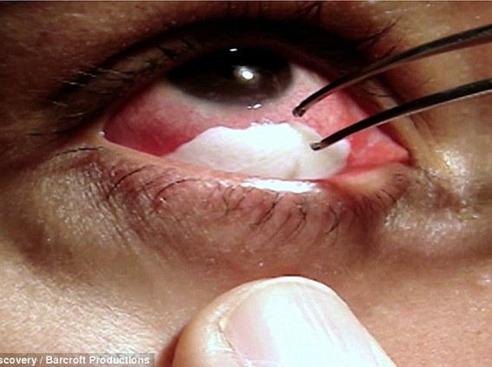 Idap Kondisi Langka, Guru TK Ini Bisa Menangis Kristal