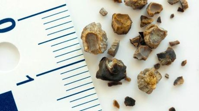 5 cara membantu mengeluarkan batu ginjal. Foto: Thinkstock 5 cara membantu mengeluarkan batu ginjal. Foto: Thinkstock