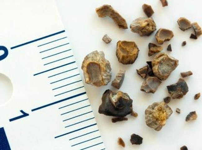 5 Hal yang Bisa Memicu Gagal Ginjal