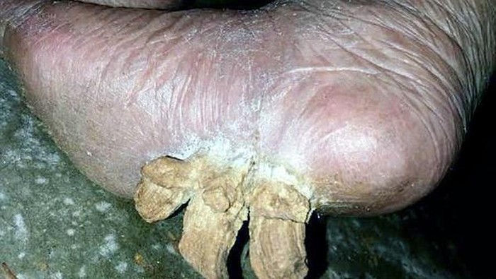 Waduh, Tiga Kuku Raksasa Tumbuh di Telapak Kaki Nenek Ini