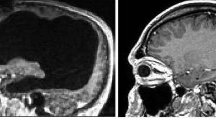 Pria Ini Tak Sadar Memiliki Otak Tak Lengkap Selama Bertahun-tahun