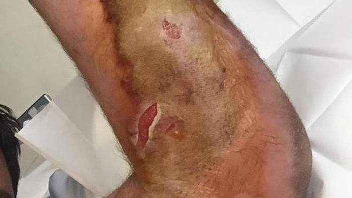 Digigit Laba-laba Langka, Muncul Balon di Lengan Pria Ini