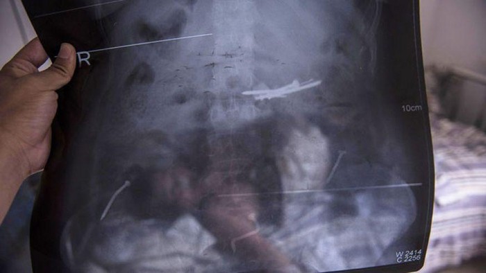 Kena Gangguan Mental Langka, Li Gemar Makan Beling dan Paku