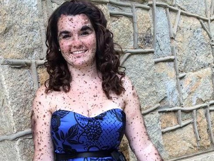 Gadis Ini Tak Takut Di-bully Meski Sekujur Tubuhnya Dipenuhi Tahi Lalat