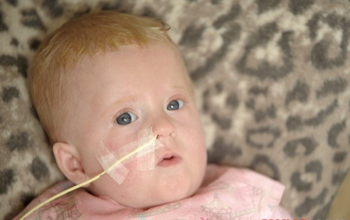 Lahir dengan Kondisi Langka, Bayi Ini Selalu Lapar dan Tak Pernah Kenyang