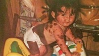 Kondisi yang dikenal dengan Giant Congenital Melanocytic Nevus (CMN) terjadi pada satu dari 500.000 orang. Meskipun merupakan tanda lahir atau tahi lalat pada saat lahir, namun sekitar 1 persen dari kasus CMN muncul setelah kelahiran, biasanya lebih banyak terjadi dalam tahun pertama kehidupan.