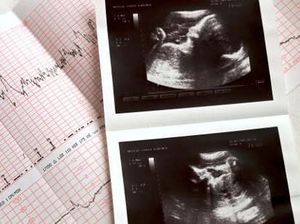 Bukan di Rahim, Wanita Ini Hamil Anaknya di Hati