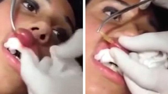 Bengkak, Ternyata Ada Belatung Tinggal dalam Bibir Wanita Ini