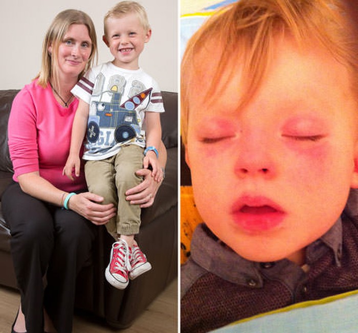 Idap Alergi Langka, Kulit Bocah Ini Jadi Gatal dan Ruam Tiap Kena Air