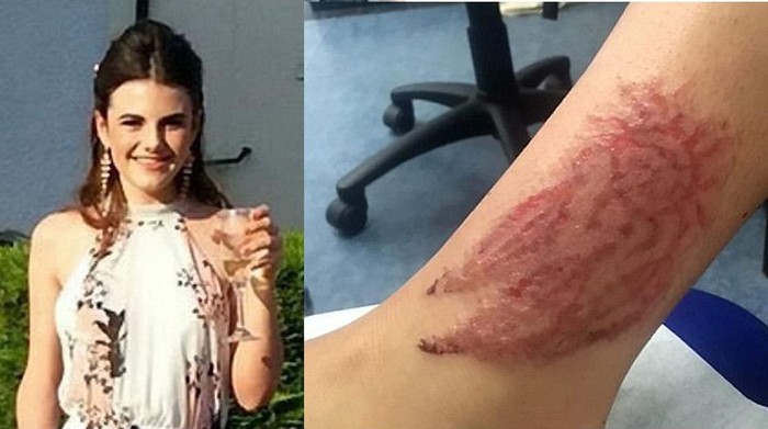 Bikin Henna Saat Berlibur ke Turki, Kulit Remaja Ini Malah Terbakar