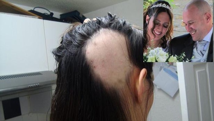 Stres Jelang Pernikahan, Rambut Calon Pengantin Rontok Hingga Botak