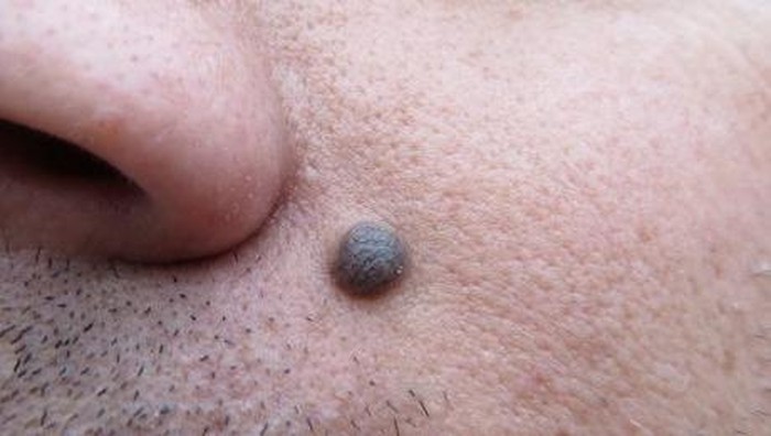 waspada tahi lalat yang bisa jadi gejala kanker kulit ganas. (Foto: thinkstock)