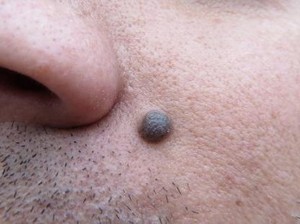 Asal-usul Nama Tahi Lalat dan Kaitannya dengan Kesehatan
