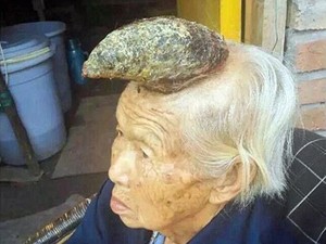 Manusia Bertanduk Benar-benar Ada, Dikhawatirkan Mengidap Kanker