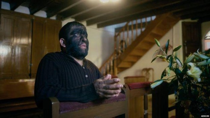 Kisah Aceves, Manusia Berbulu Lebat yang Dipanggil Manusia Serigala