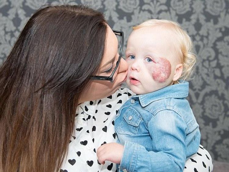 Potret Sonny, Bocah dengan Tanda Lahir Unik Sebesar Bola Kriket