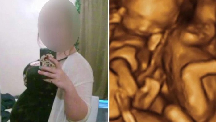 10 Bulan Tak Kunjung Melahirkan, Gadis ini Ternyata Cuma Pura-pura Hamil
