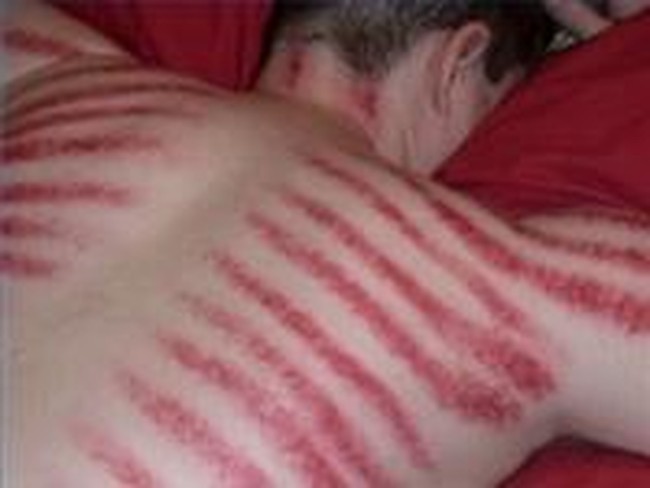 Gemar Kerokan? Ini 5 Hal yang Anda Perlu Tahu