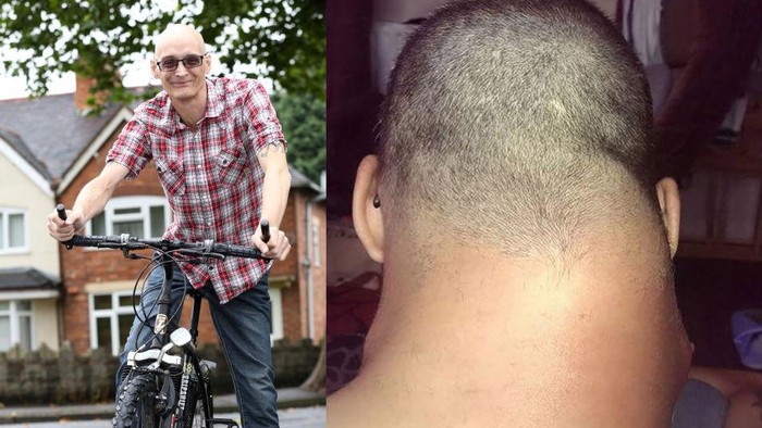 Sebulan Jatuh dari Sepeda, Muncul Tumor Sebesar Melon di Leher Pria Ini