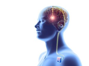 Mengenal Deep Brain Stimulation, Terapi Khusus untuk Pengidap Parkinson