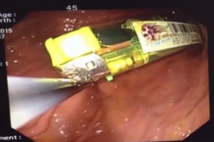 Diduga Mabuk Terpengaruh Obat, Pria Ini Tak Sengaja Telan Pemantik Api