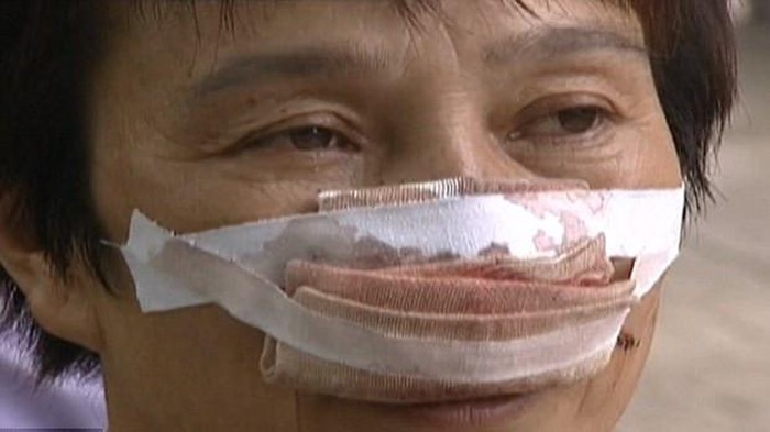 Marah karena Telepon Tak Diangkat, Suami Tega Gigit dan Telan Hidung Istri