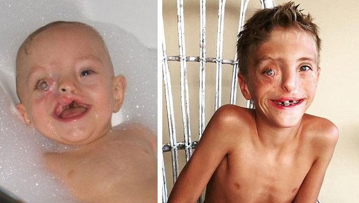 Bocah dengan Bibir Sumbing Ekstrem, Wajahnya Seperti Rusak Sebelah