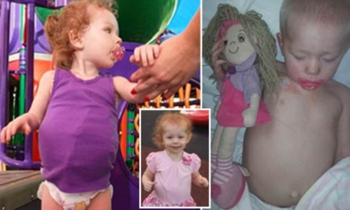 Idap Kanker, Bocah Ini Hidup dengan Tumor Seukuran Bola Sepak di Perut