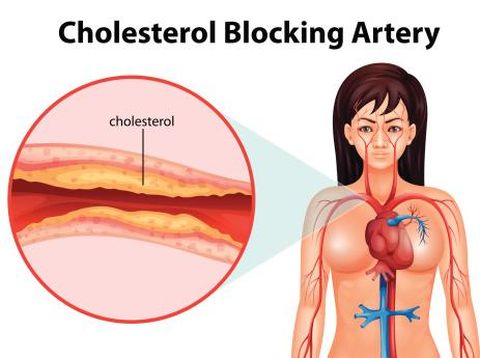 Kolesterol tinggi dapat menyebabkan penyumbatan pembuluh darah jantung