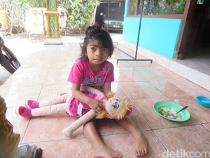 Selain Farhan di Bantul, Vivi di Sleman Juga Mengidap Kondisi Langka CdLS