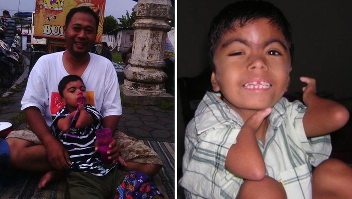 Jadi Aktivis CdLS Indonesia, Begini Harapan Koko Prabu