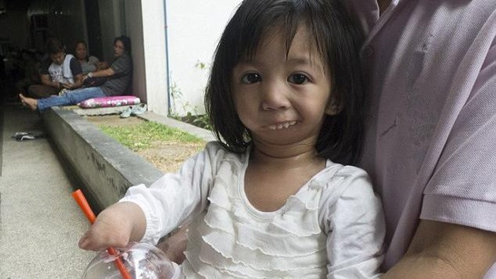 Lahir dengan Mulut Menutup, Bocah Filipina ini Akhirnya Dioperasi