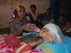 Pilu! Ukuran Kepala Batita Ini Mencapai 58 cm karena Idap Hidrosefalus