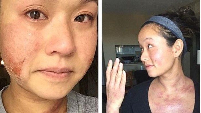 Ingin Montok dan Tampil Menarik, Wanita Ini Malah Kena Eksim