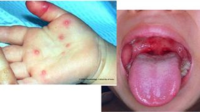 Flu Singapura. Foto: JKN Sarawak Flu Singapura. Foto: JKN Sarawak