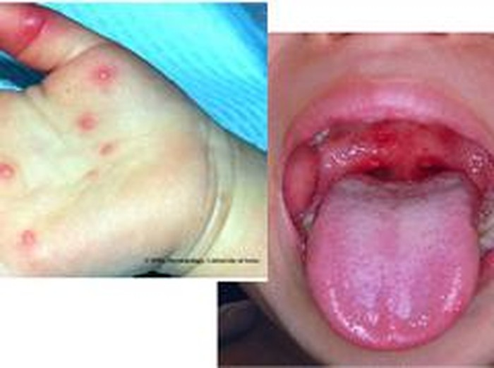 Saat Anak Kena Flu Singapura, Ini Saran dari Dokter