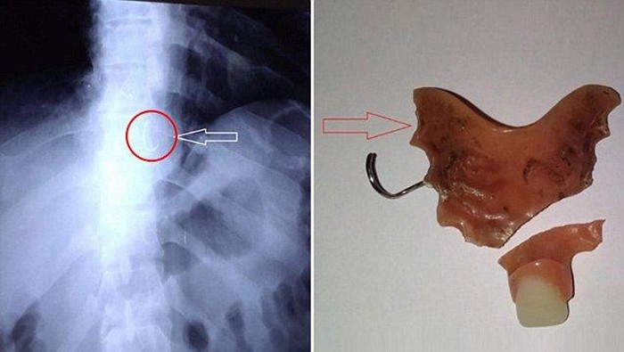 Kena Serangan Epilepsi, Pria Ini Tak Sengaja Telan Gigi Palsunya