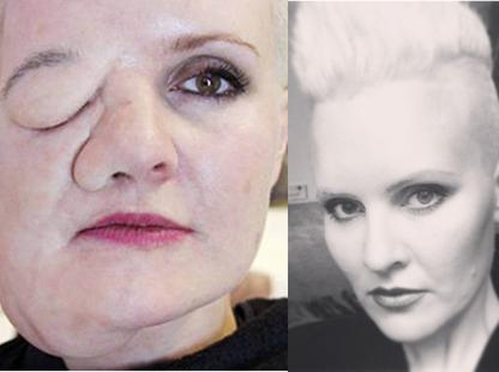 Idap Body Dysmorphic Disorder, Leigh Coba Tumbuhkan Tumor di Wajah