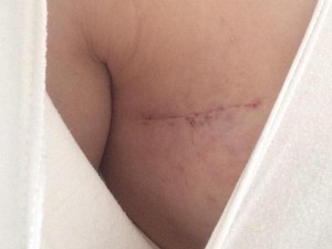 Survivor Kanker Payudara Ramai-ramai Tunjukkan Luka Operasi Mastektomi