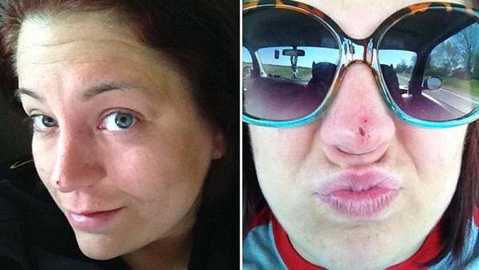 Kanker Kulit, Bree Dibuatkan Belalai sebagai Cikal-bakal Hidung Barunya