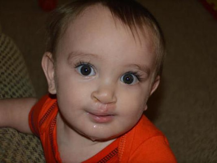 Dikira Punya Kanker di Wajah, Conan Lahir Selamat Berkat Printer 3D