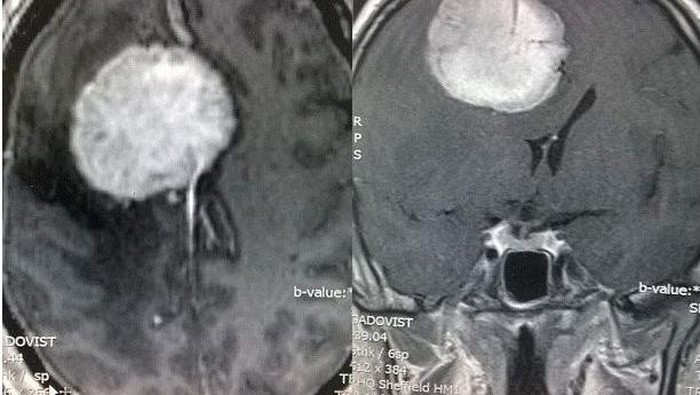 Sering Depresi, Wasit Ini Ternyata Punya Tumor di Otaknya
