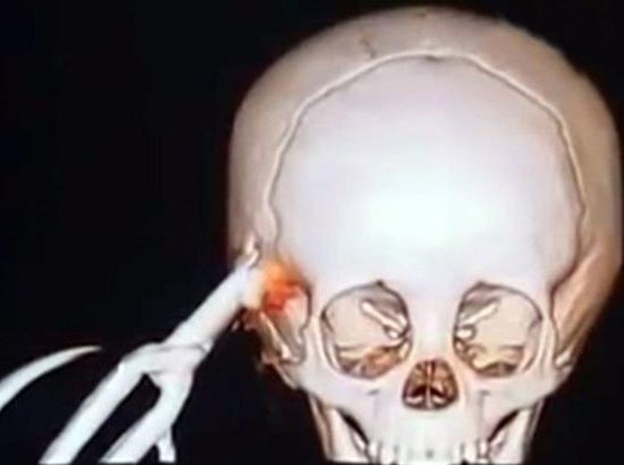 Tersandung Lalu Jatuh, Kepala Bocah 2 Tahun Ini Tertusuk Gunting