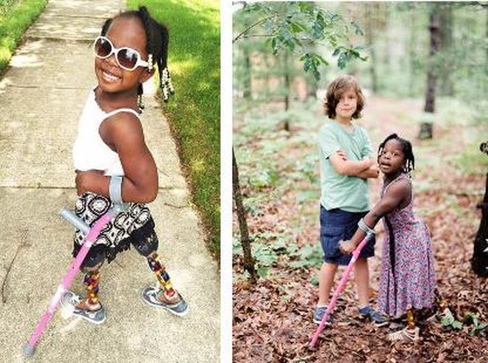 Cerita Bocah 6 Tahun yang Sering Di-bully karena Pakai Kaki Prostetik