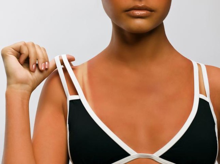 Sunburn Juga Bisa Terjadi di Tengah Cuaca Berangin Lho